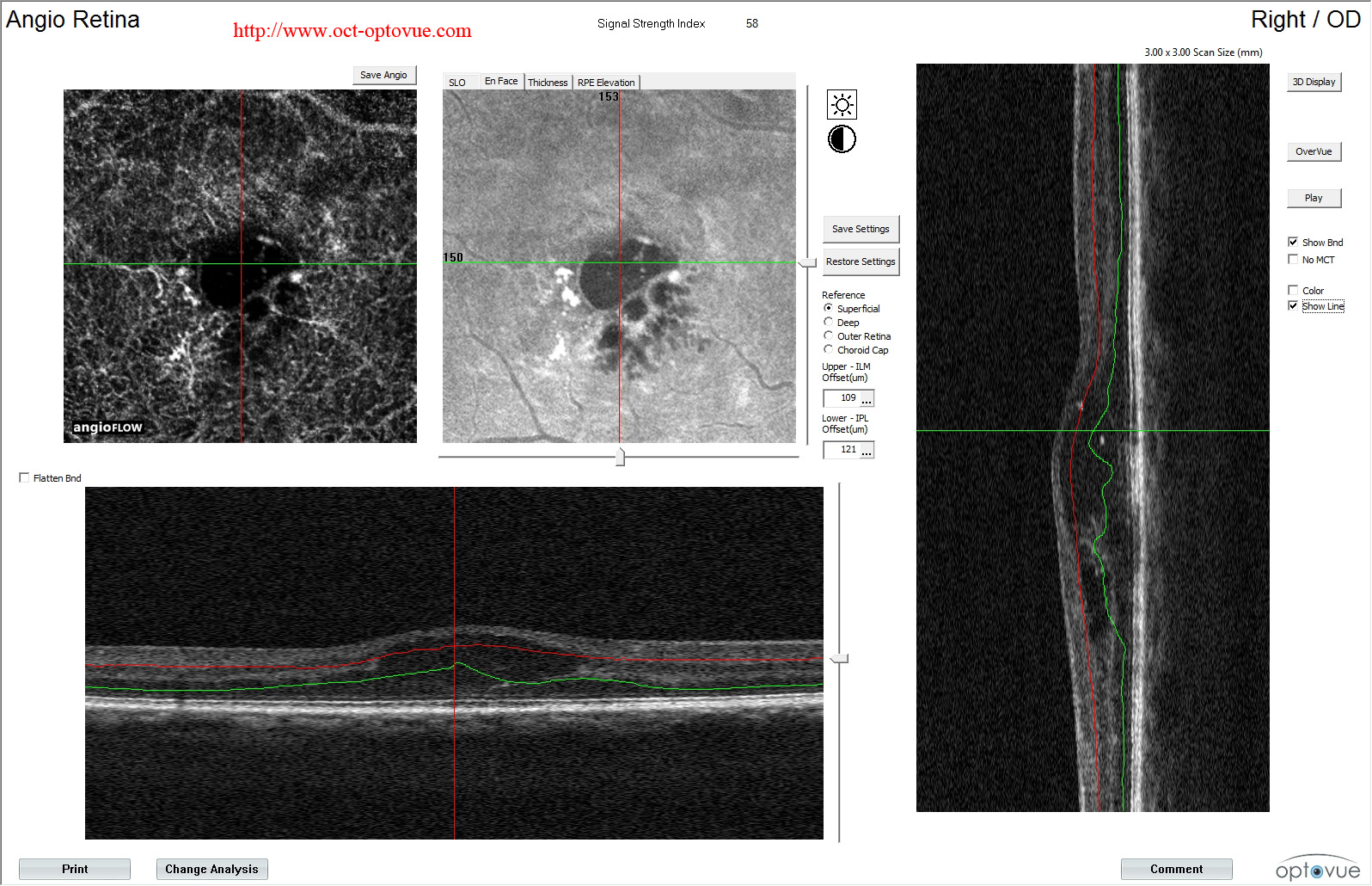 diabetes octa retina 