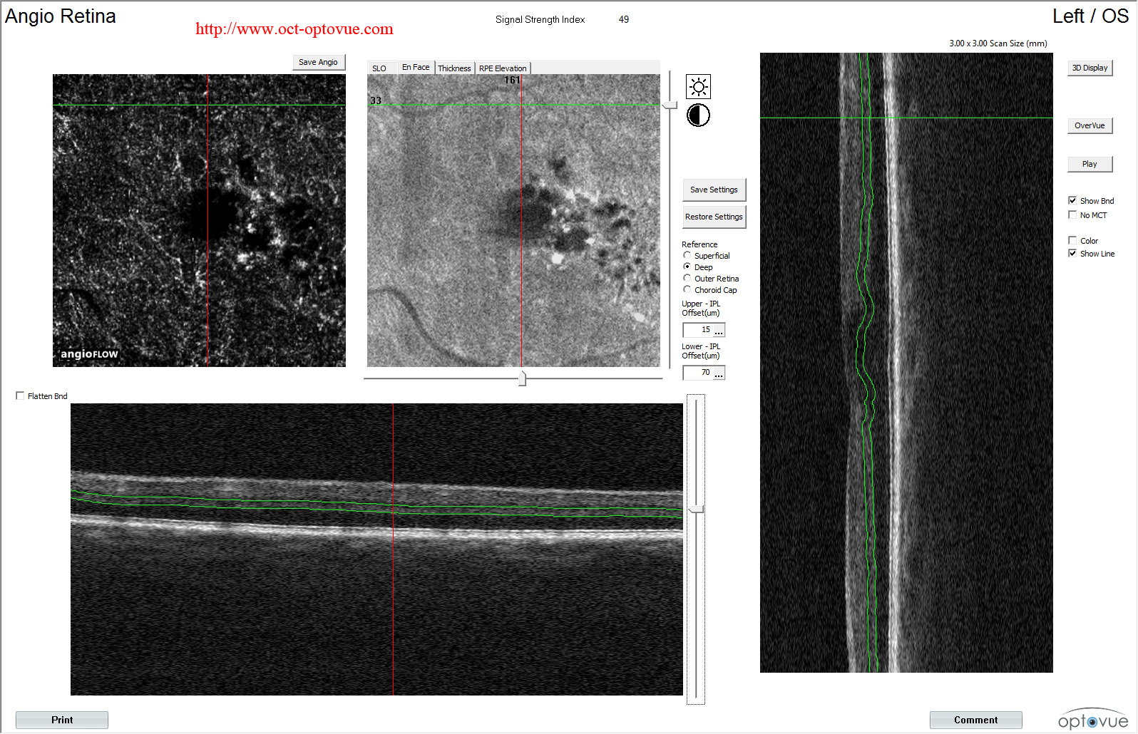 diabetes-octa-left angio retina