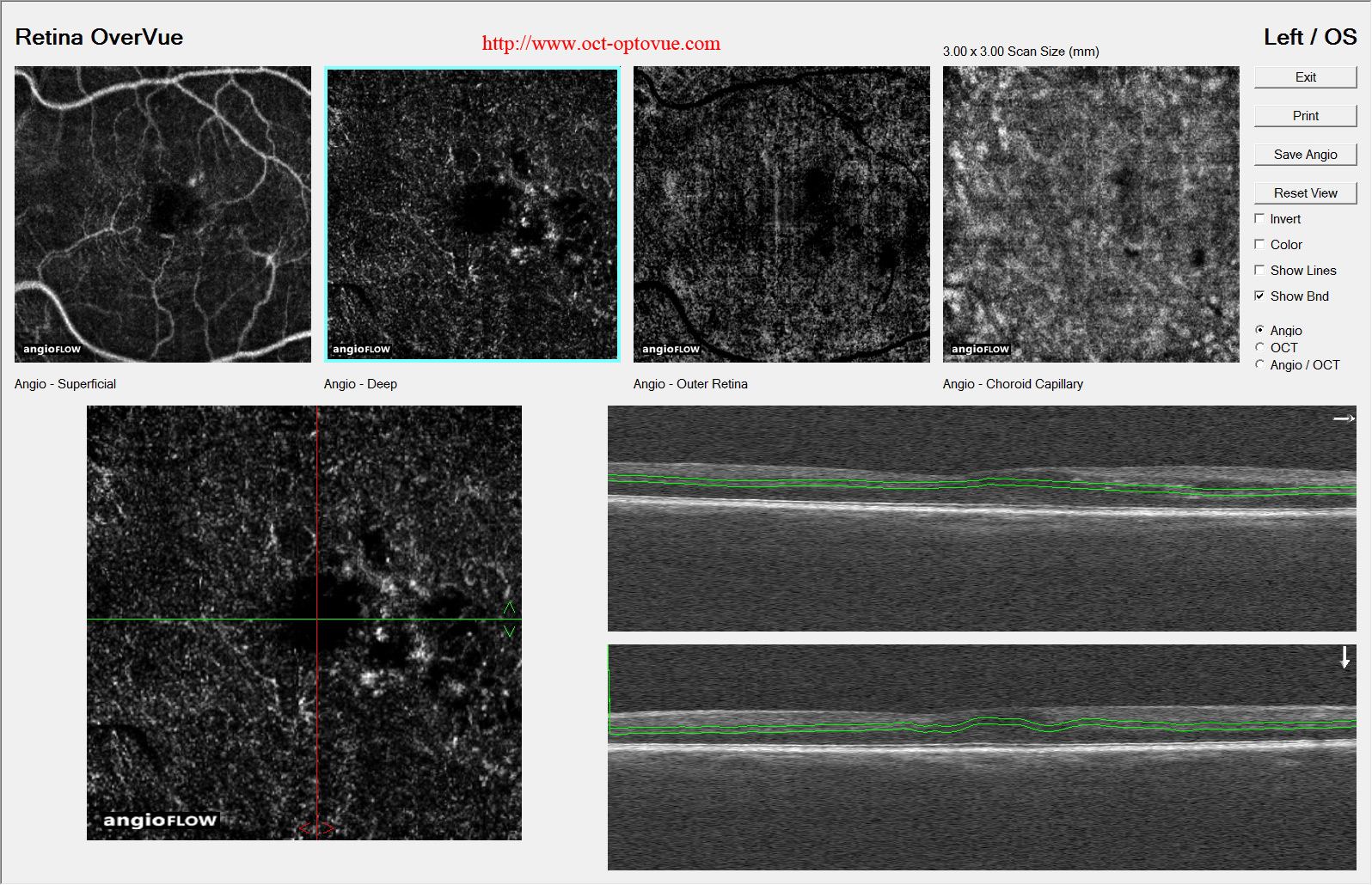 diabetes octa left overvue