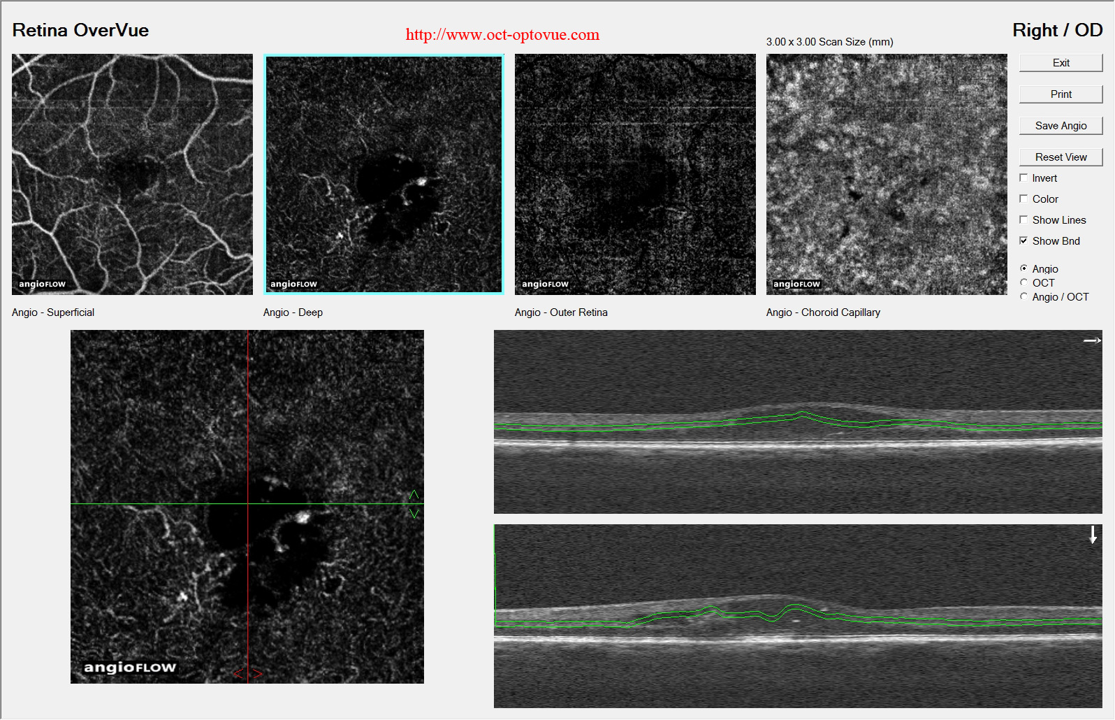 diabetes octa rigth eye