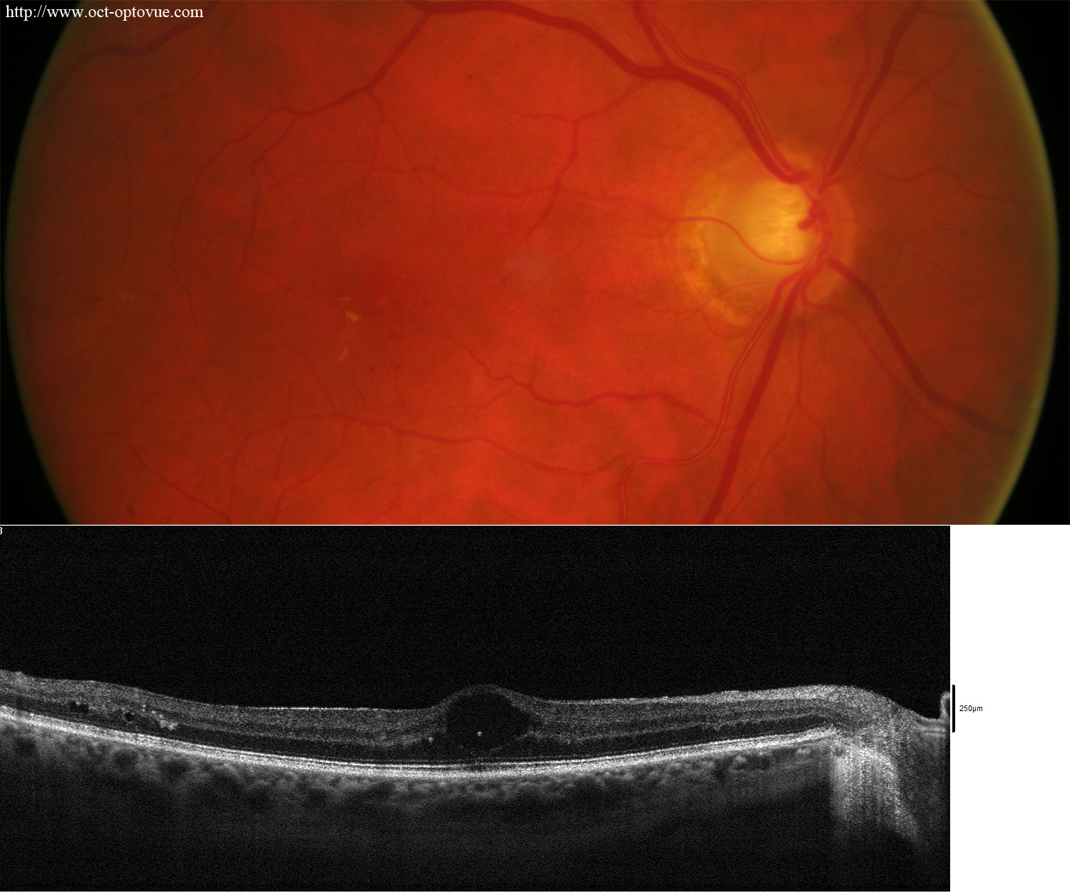 diabetes oct angiography