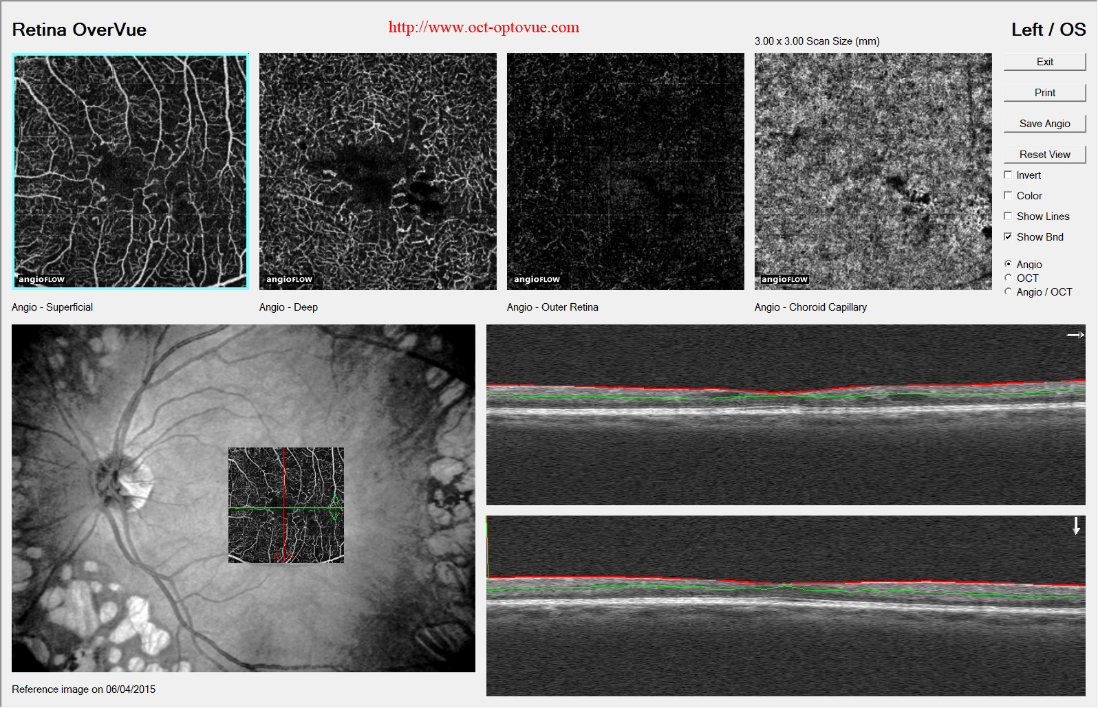 angio-oct-diabete retina disease