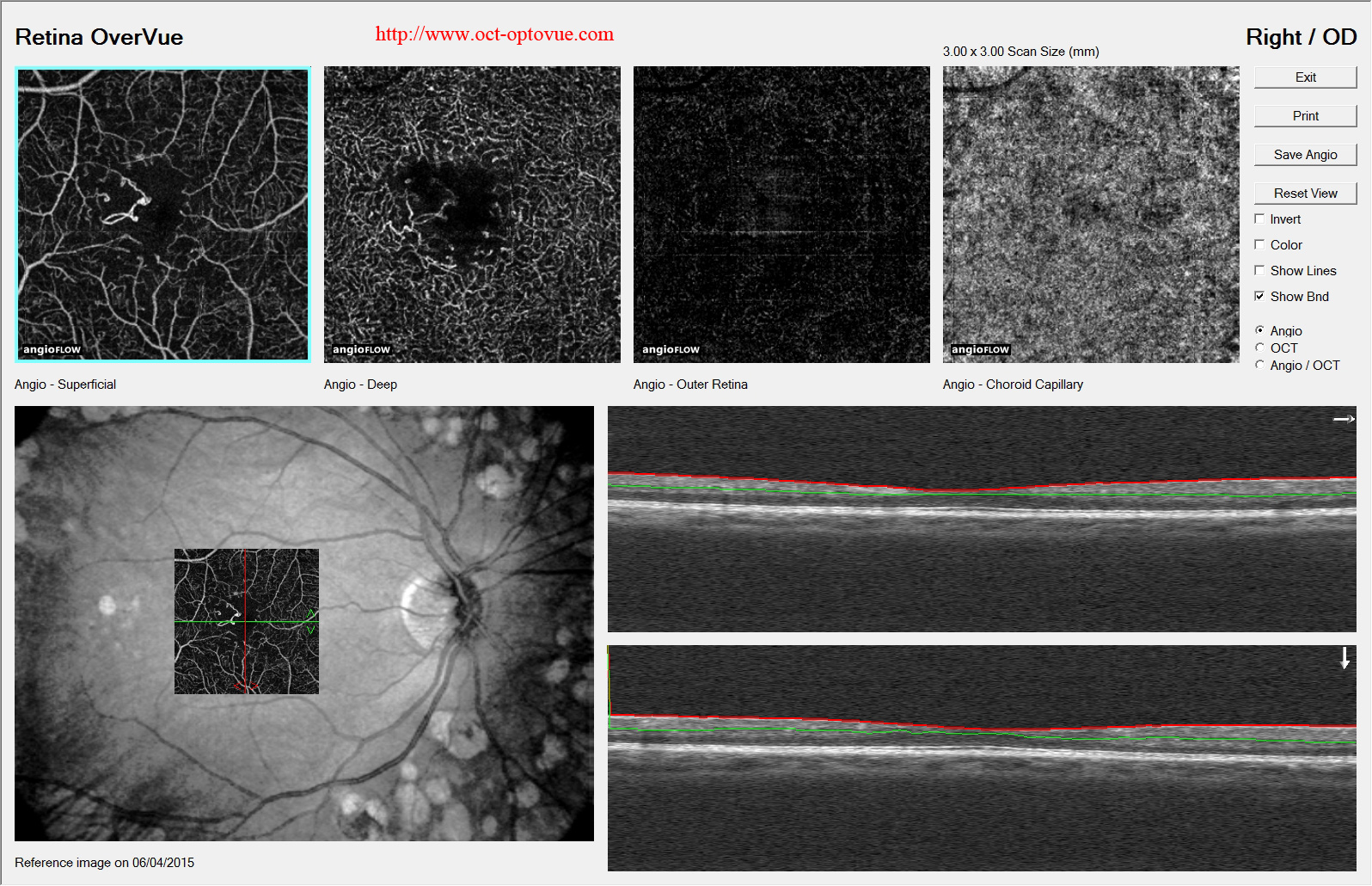 diabetes angio-oct laser