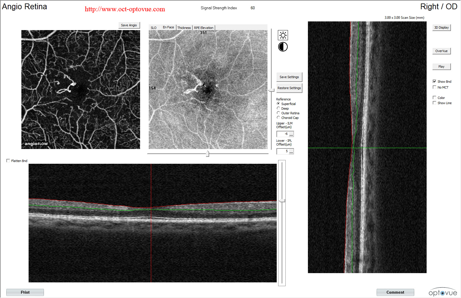 diabetes oct angiographry retina capillary