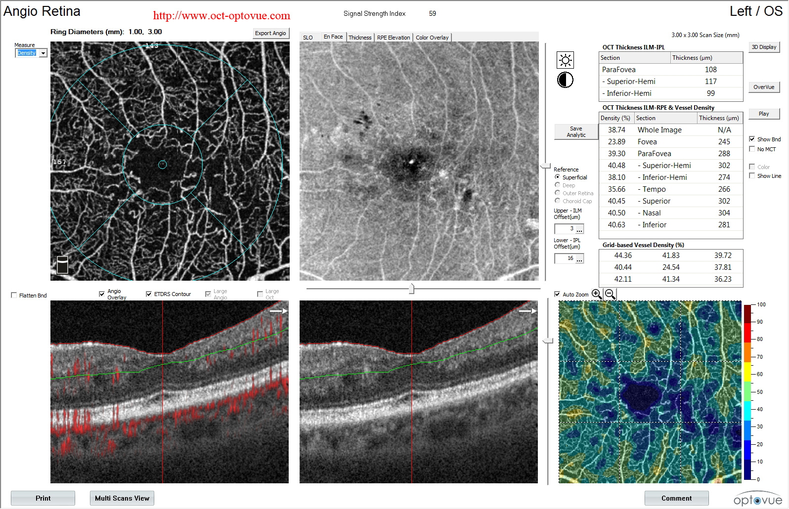 diabetes evolution macula density angioanalytics