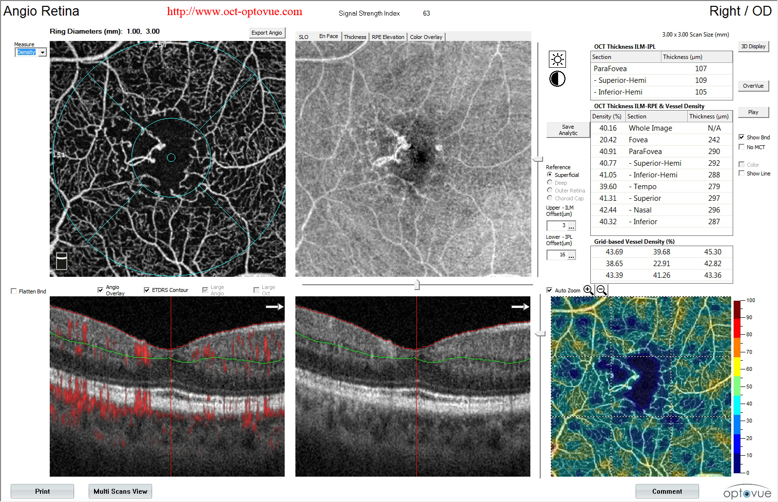 diabetes evolution octa angioanalytics