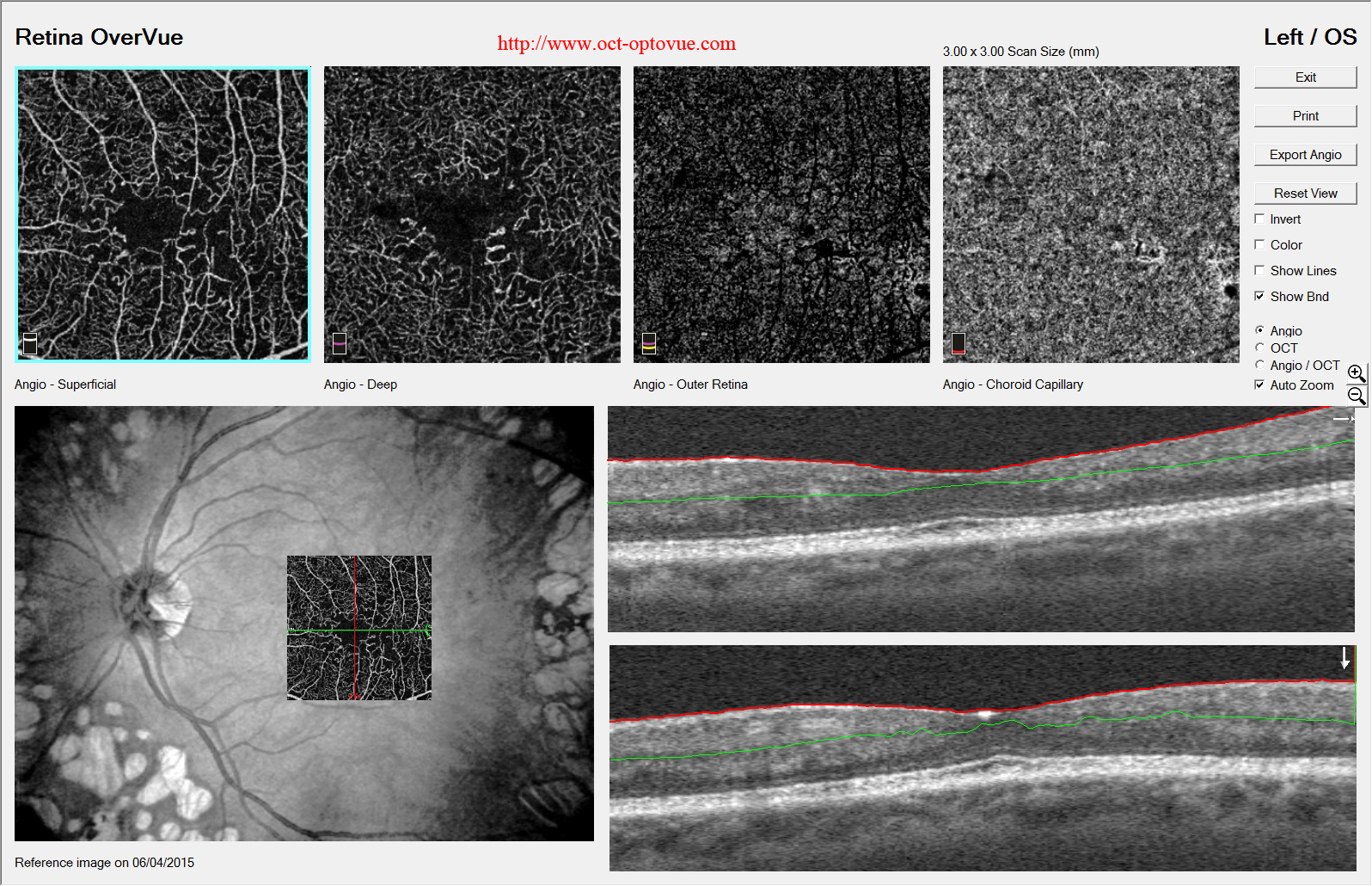 diabetes evolution retina