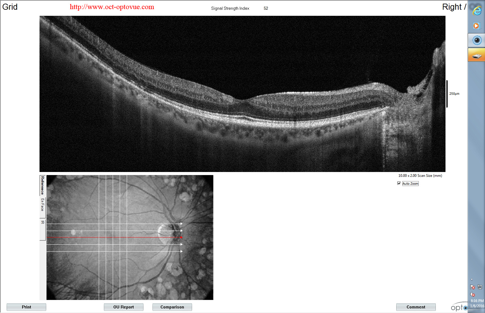 diabetes oct-retina optovue