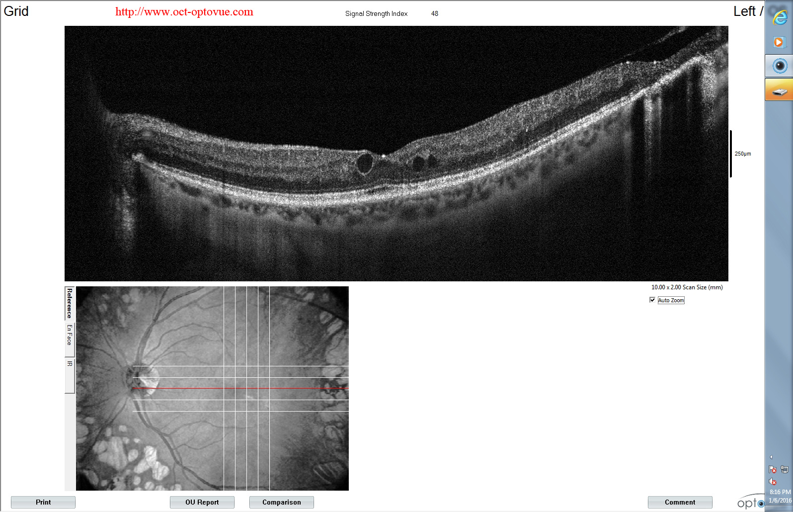 oct diabetes retina oedema