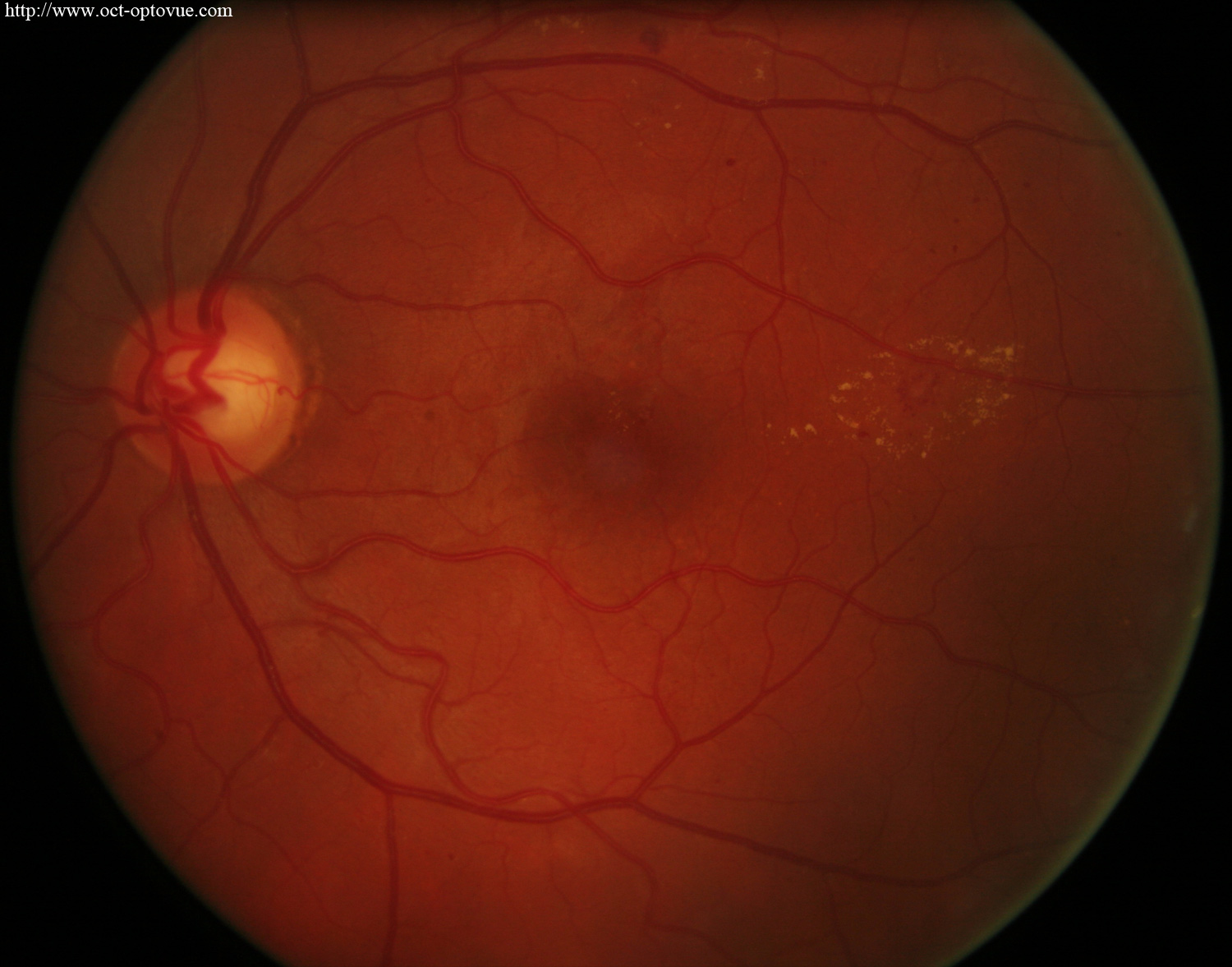 optical-coherence-tomography-angio