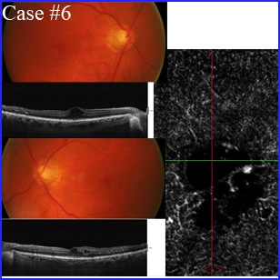 diabetes-octangio retina