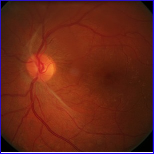 octa proliferative retinopathy diabetes