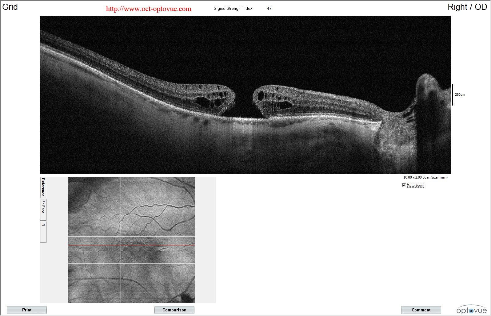 oct macular hole trou maculaire