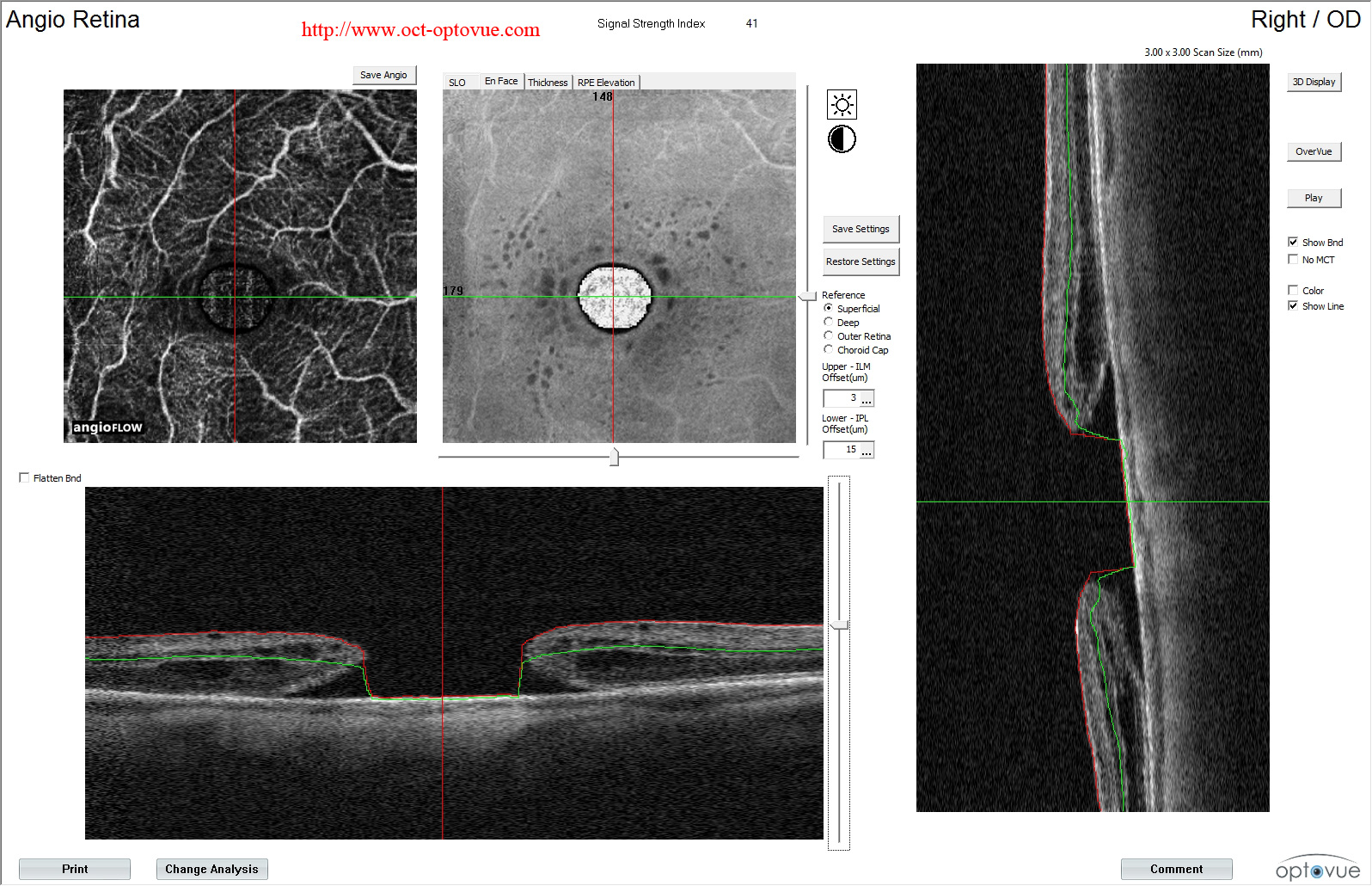 octa macular-hole tm muratet pamiers