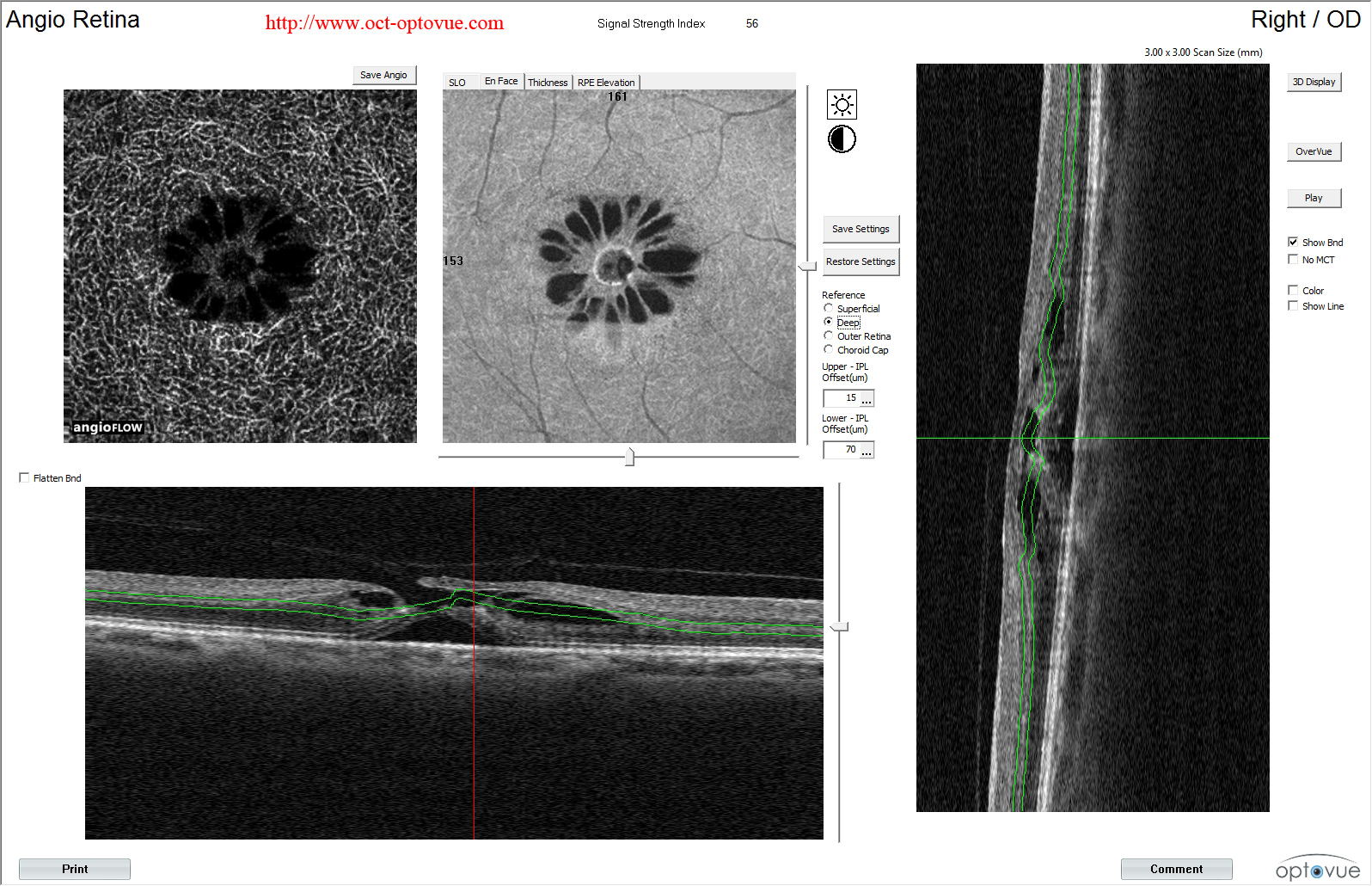 macular-hole-angio-oct enface