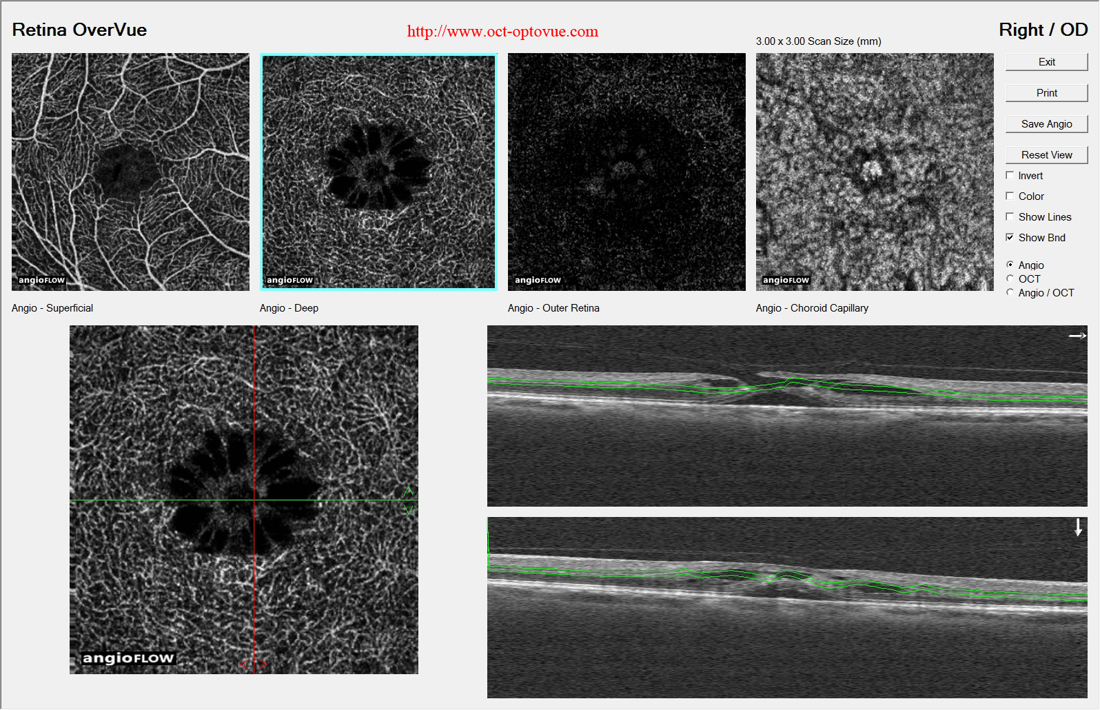 macular-hole angiography oct angiographie