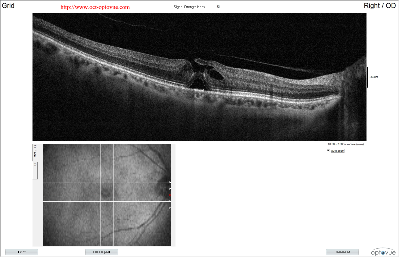 macular-hole oct trou maculaire