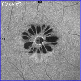 macular-hole oct angiography trou maculaire angiographie