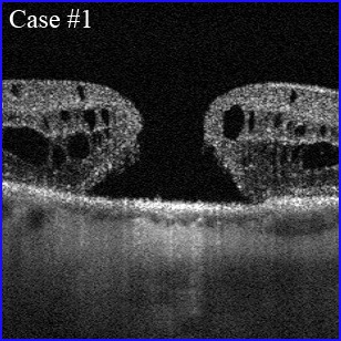 oct-macular-hole-304