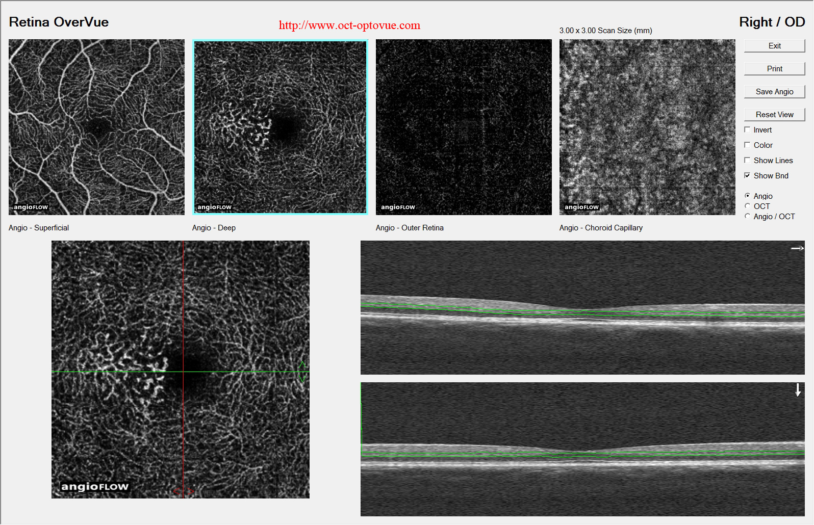 oct-angio MacTel2 macular telangiectasia