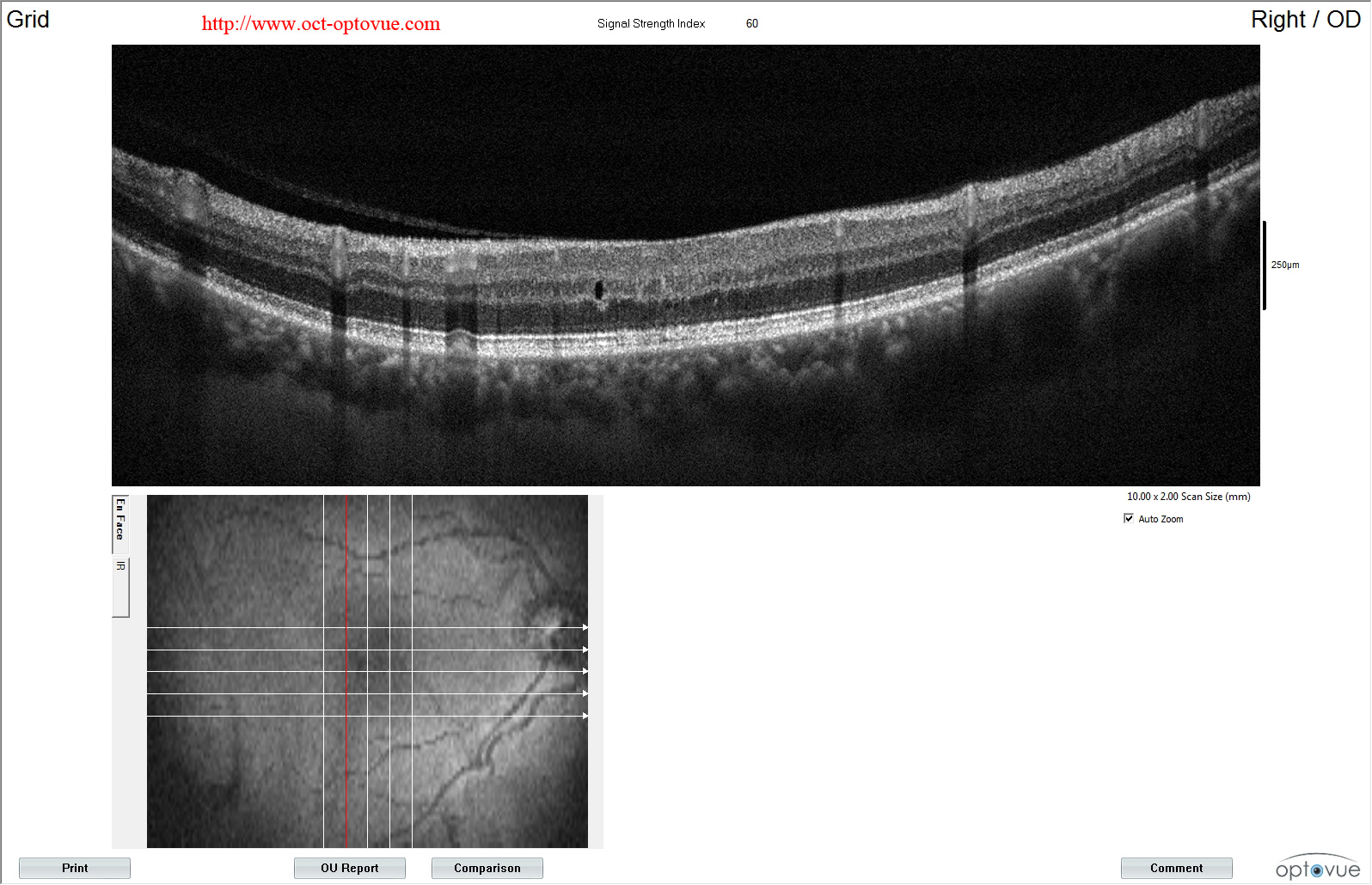 macular retina telangiectasia group2