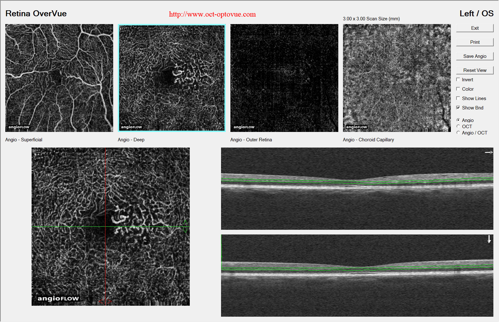 macular telangiectasia oct angiography telangiectasies