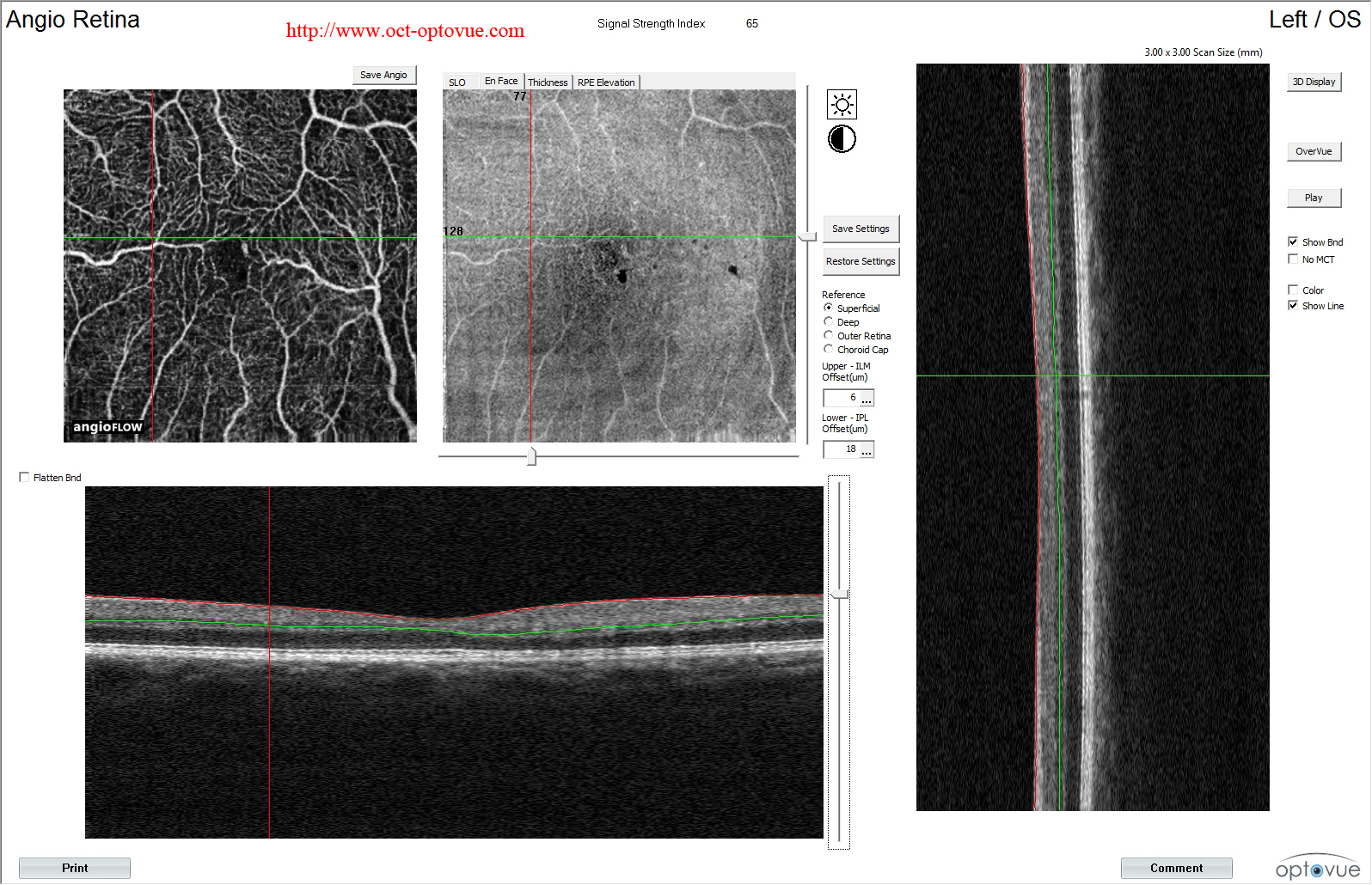 macular telangiectasia oct angiography 