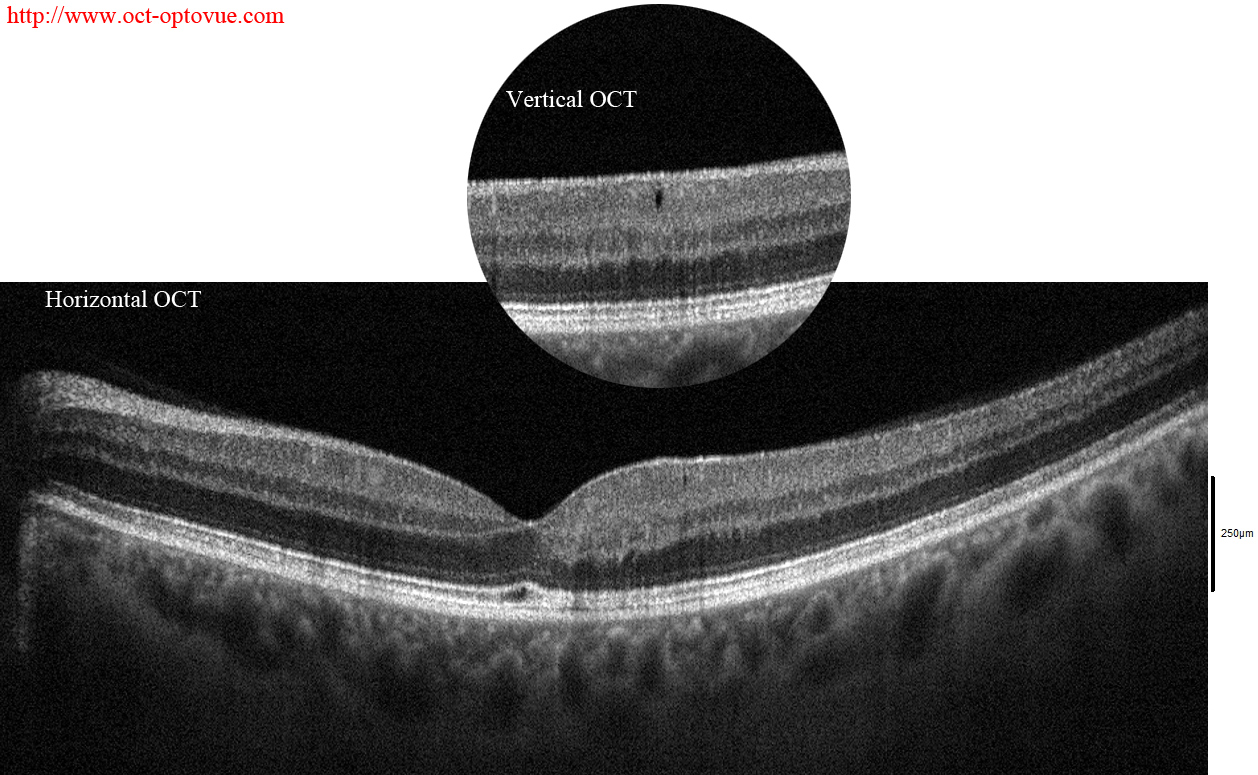 macular telangiectasia oct angiography 