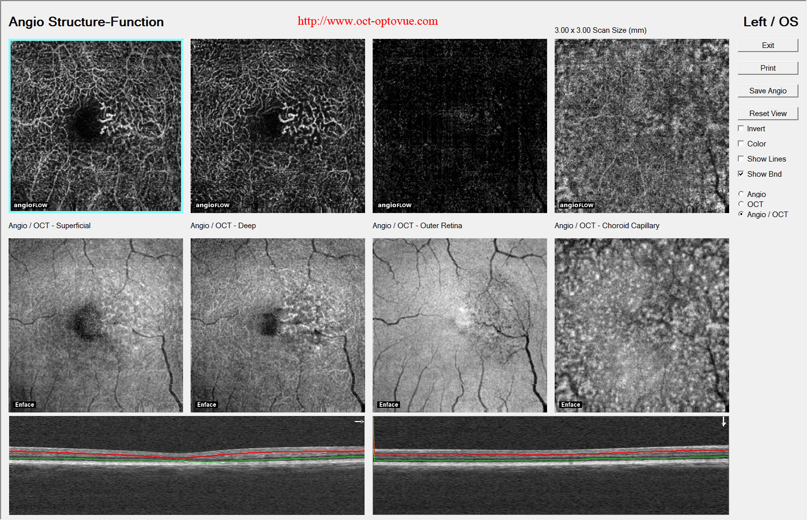 macular telangiectasia oct angiography  en face
