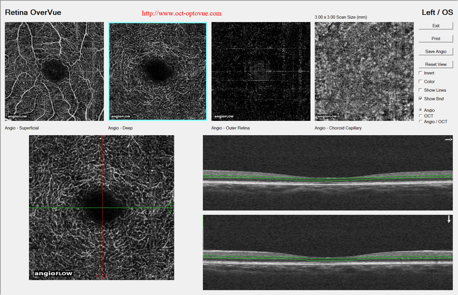 mactel-oct-angiography fellow eye