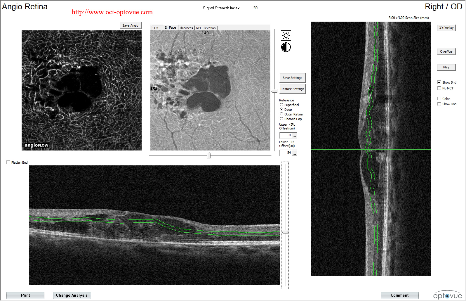 telangiectasia mactel oct angiography coats disease