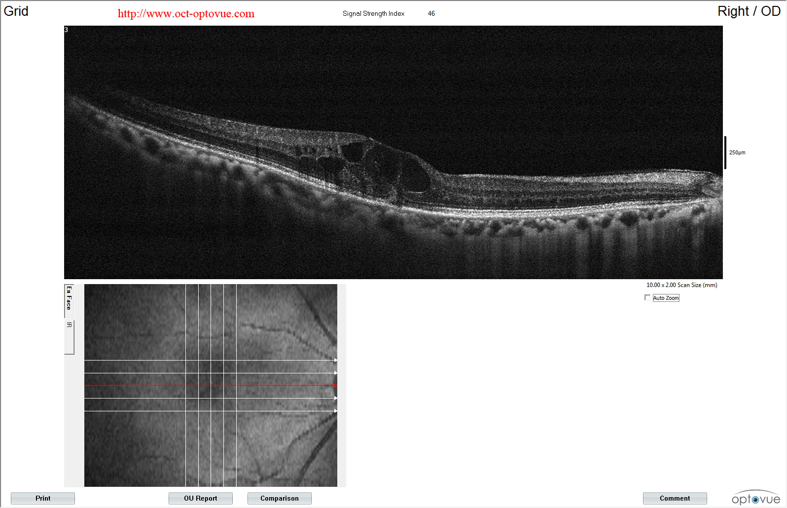 telangiectasia mactel1 oct coats disease