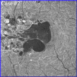 coats disease mactel 1 telangiectasia