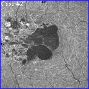 coats disease mactel 1 telangiectasia