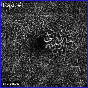 macular telangiectasia oct angiography