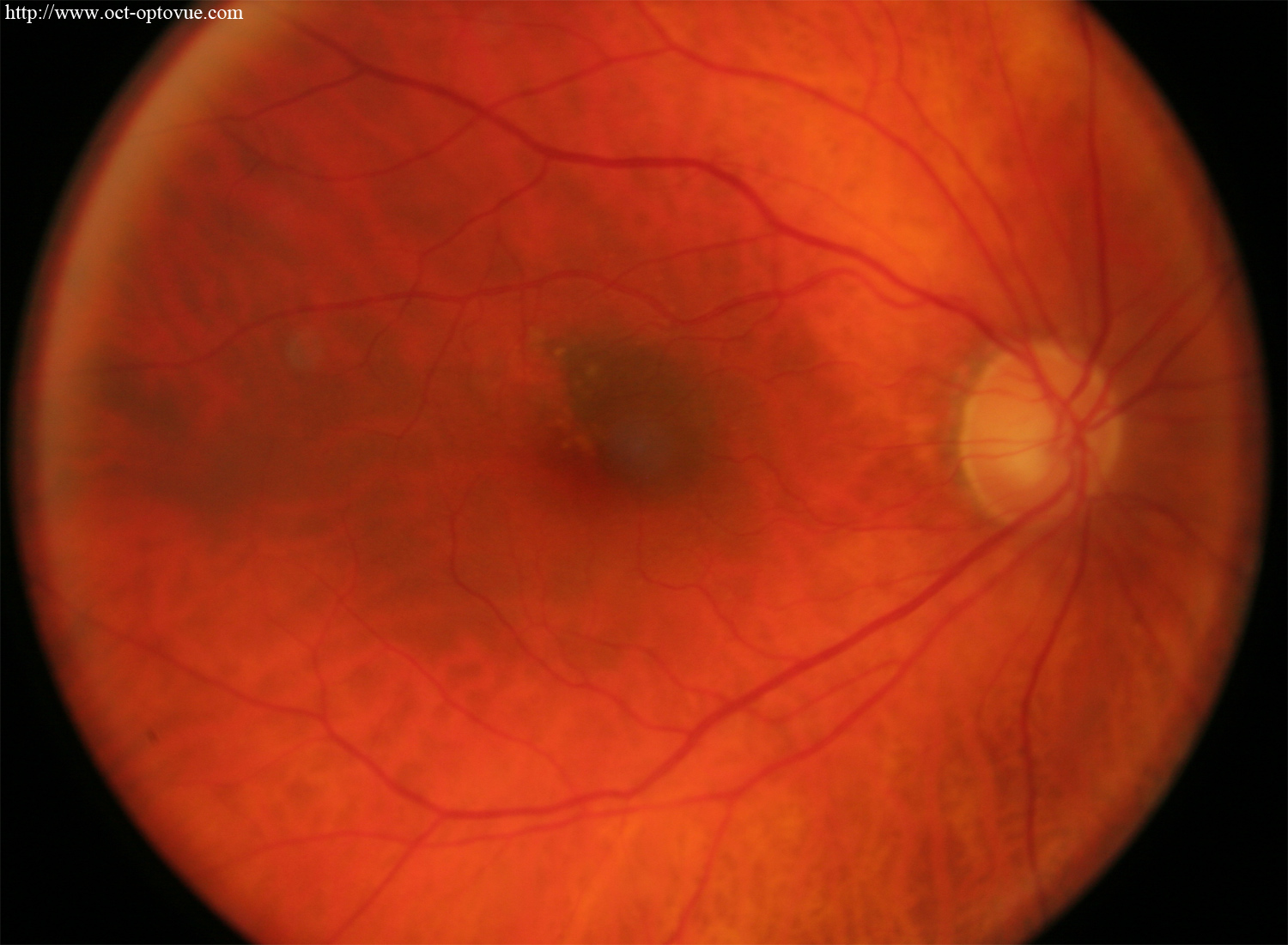 nevus choroidal retina oct-angiography