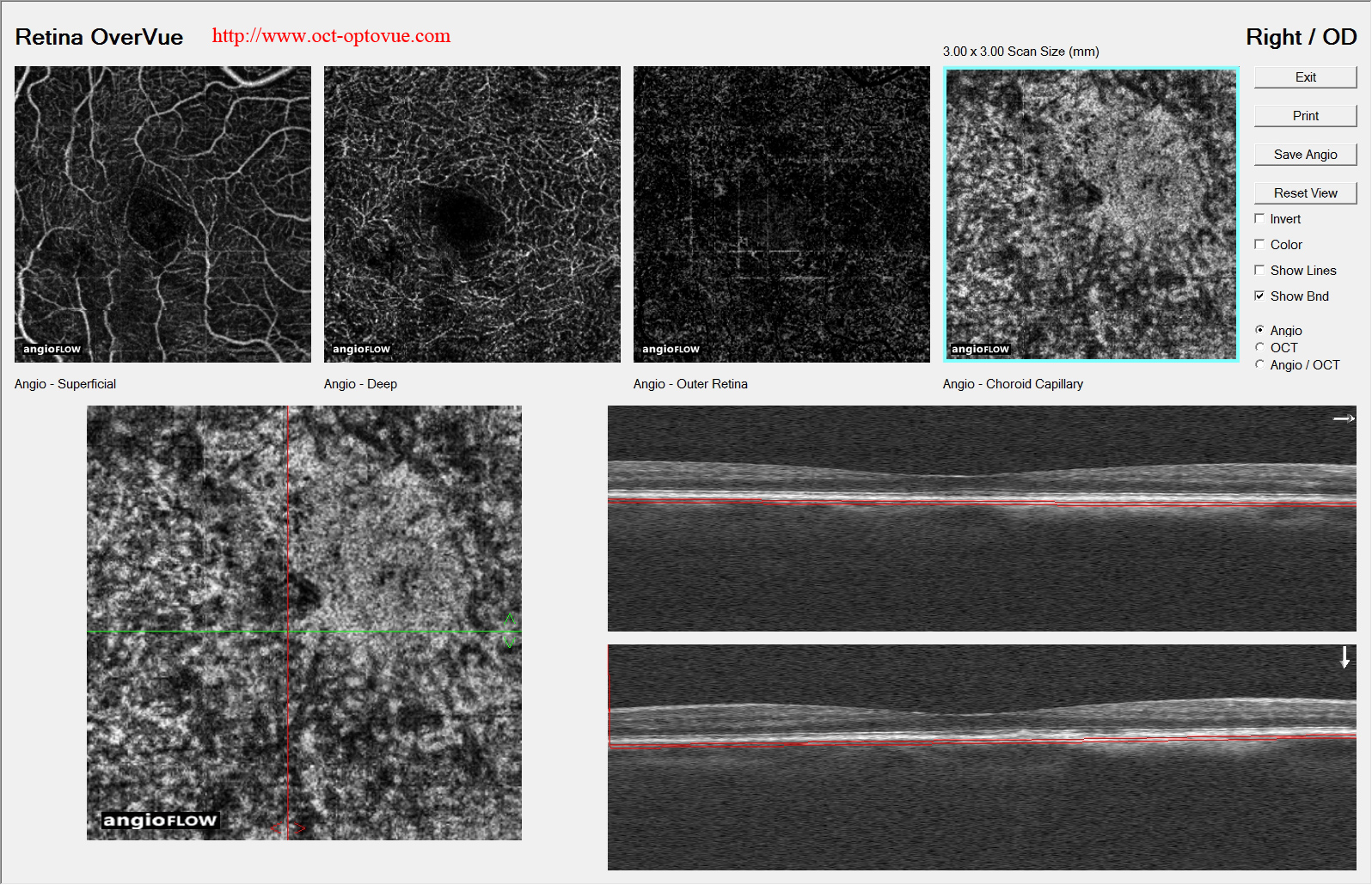nevus-choroidal retina angio-oct