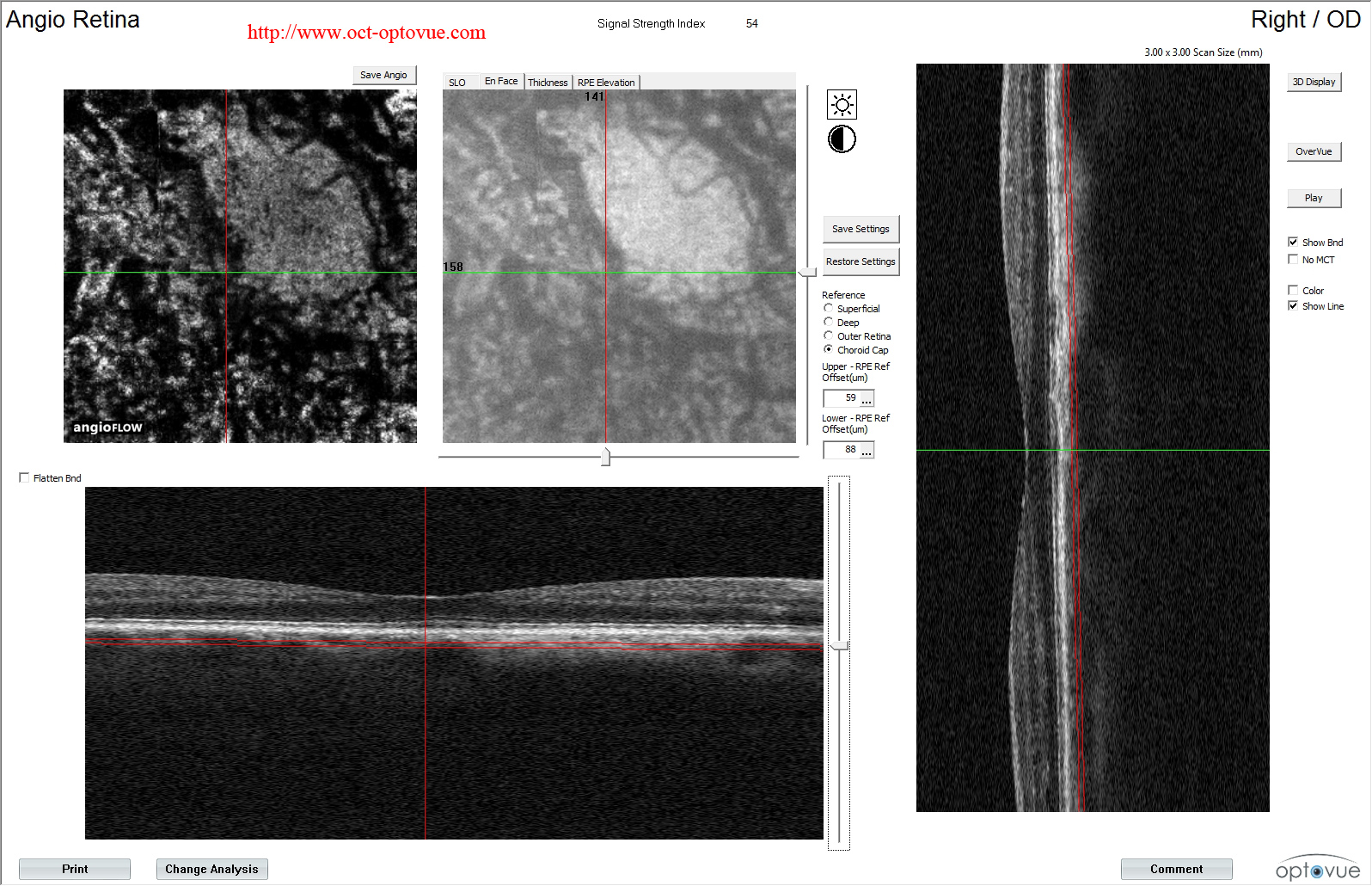 nevus chorodial-oct-angiography