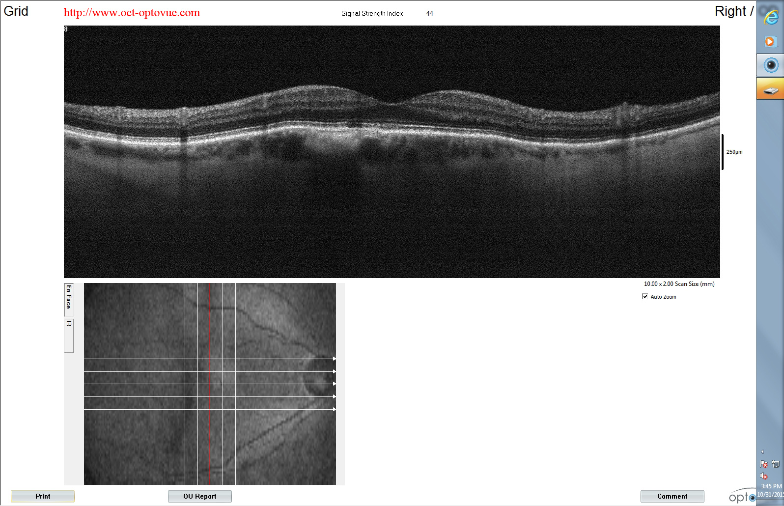 nevus choroidal optical coherence tomography oct