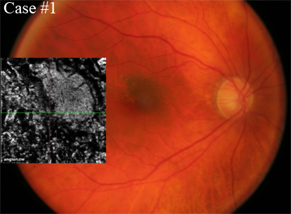 choroidal nevus oct-angiography 