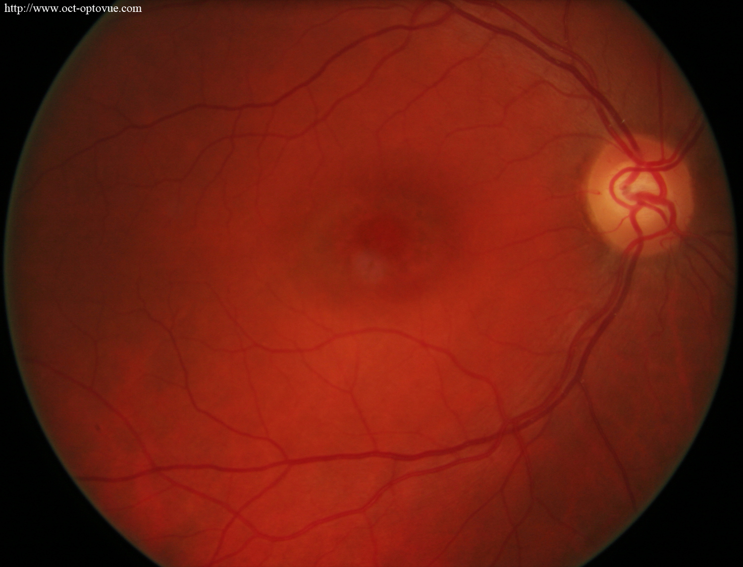 chloroquine maculopathy hydroxychloroquine angio oct