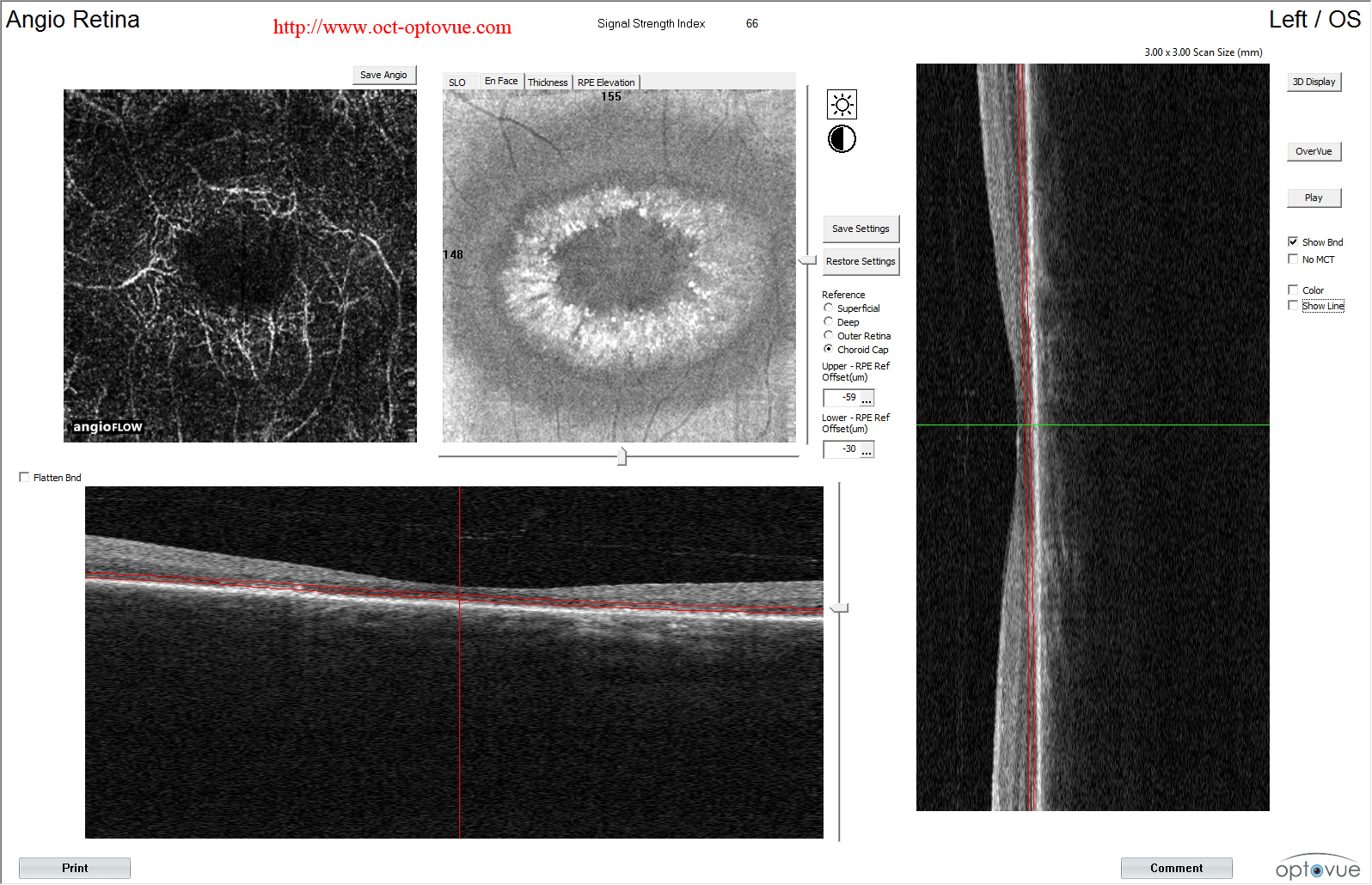 hydroxychloroquine blind chloroquine maculopathy angio oct octa