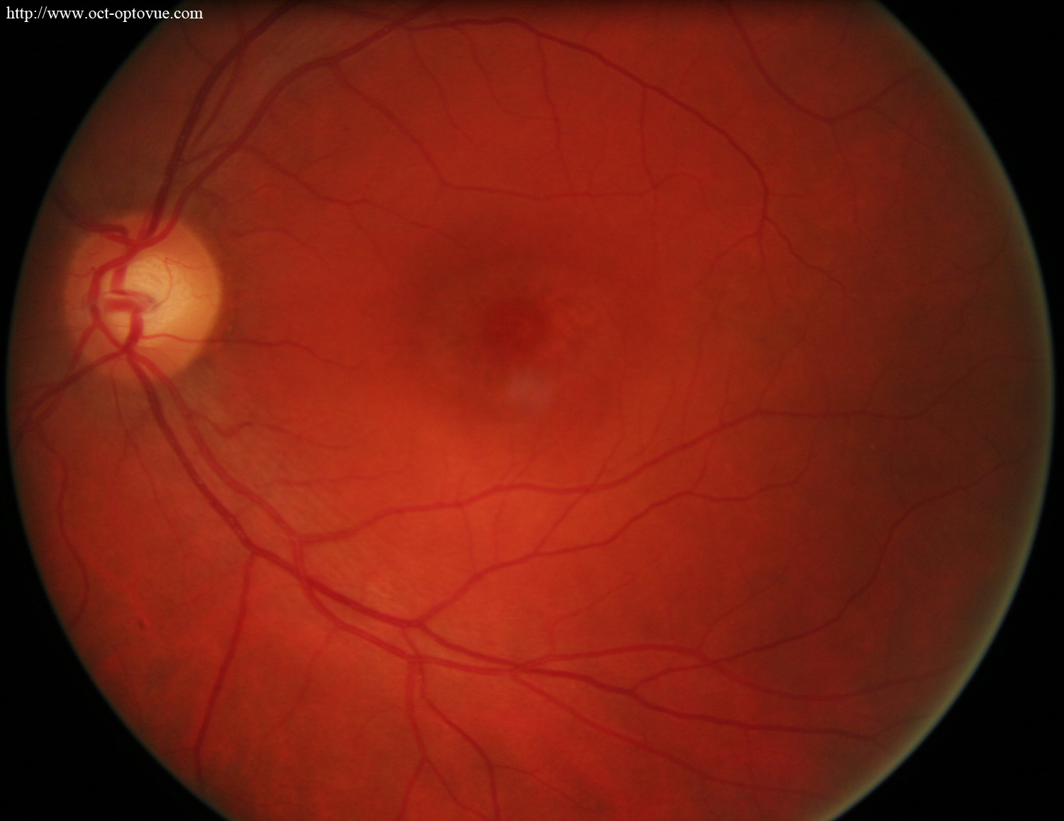 hydroxychloroquine-maculopathy