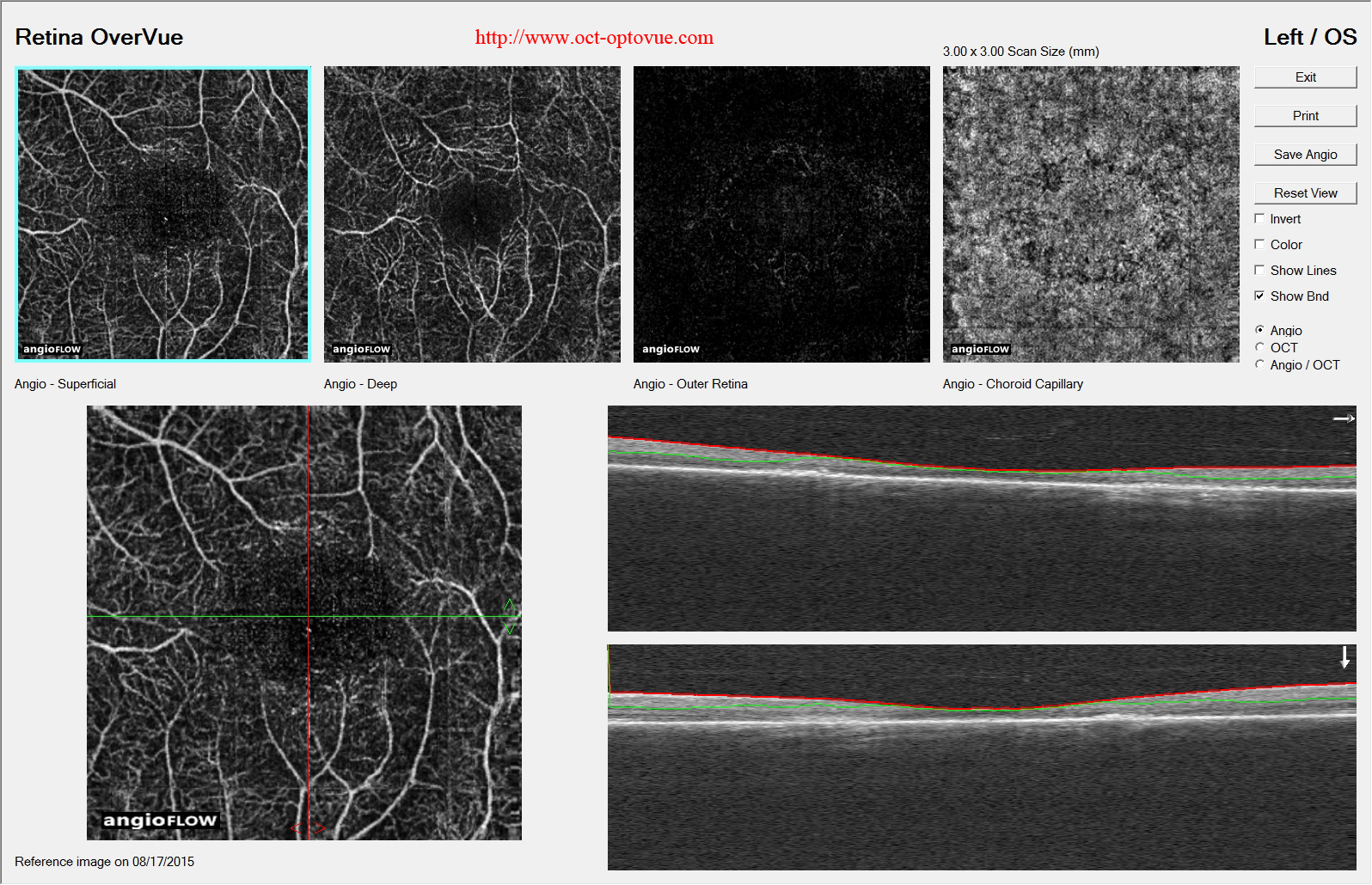 chloroquine maculopathy hydroxychloroquine oct angiography oct