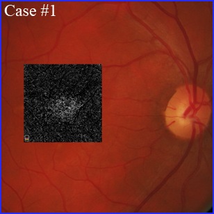 stargardt disease oct angiography