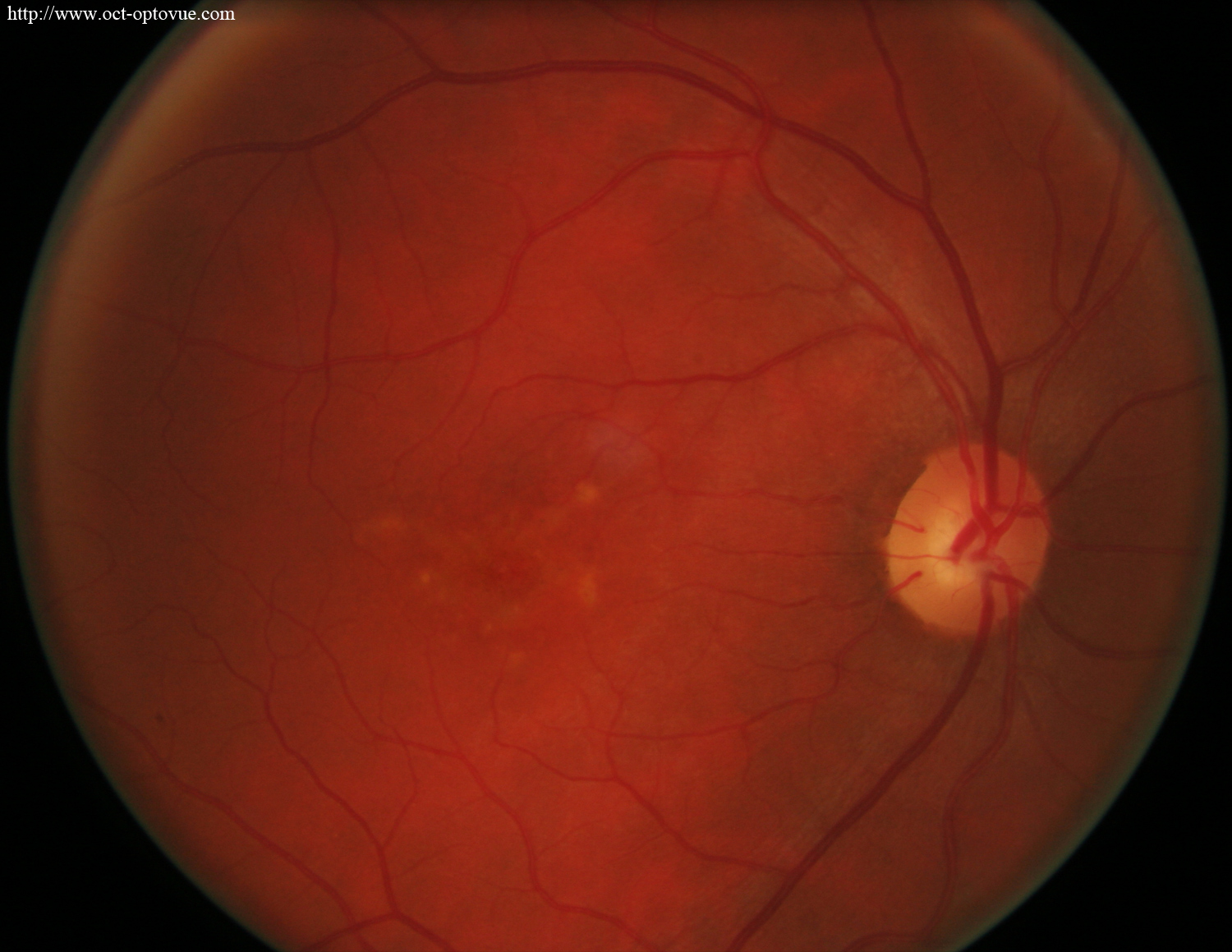 stargardt disease oct angiography