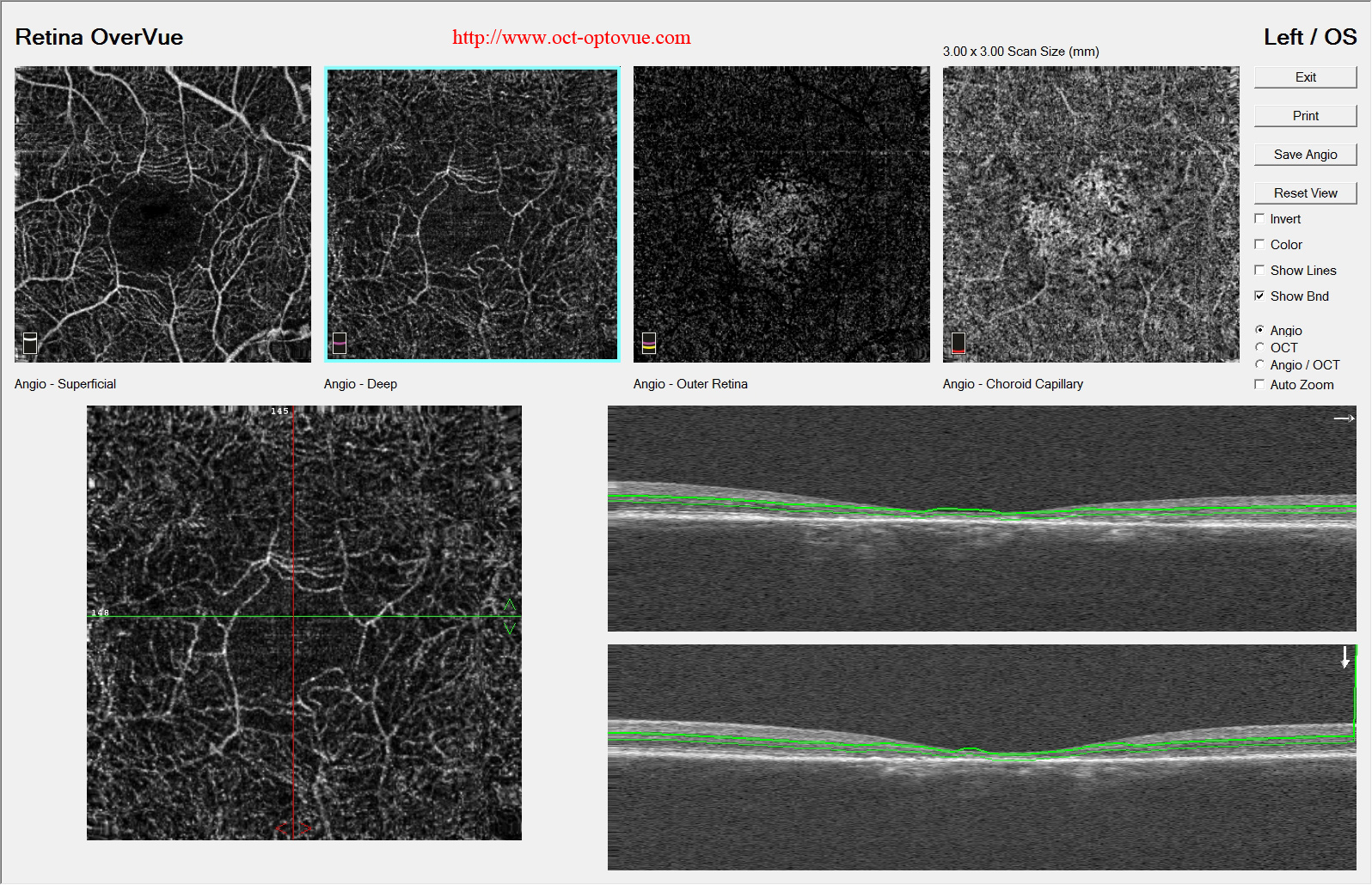 stargardt oct-angiography