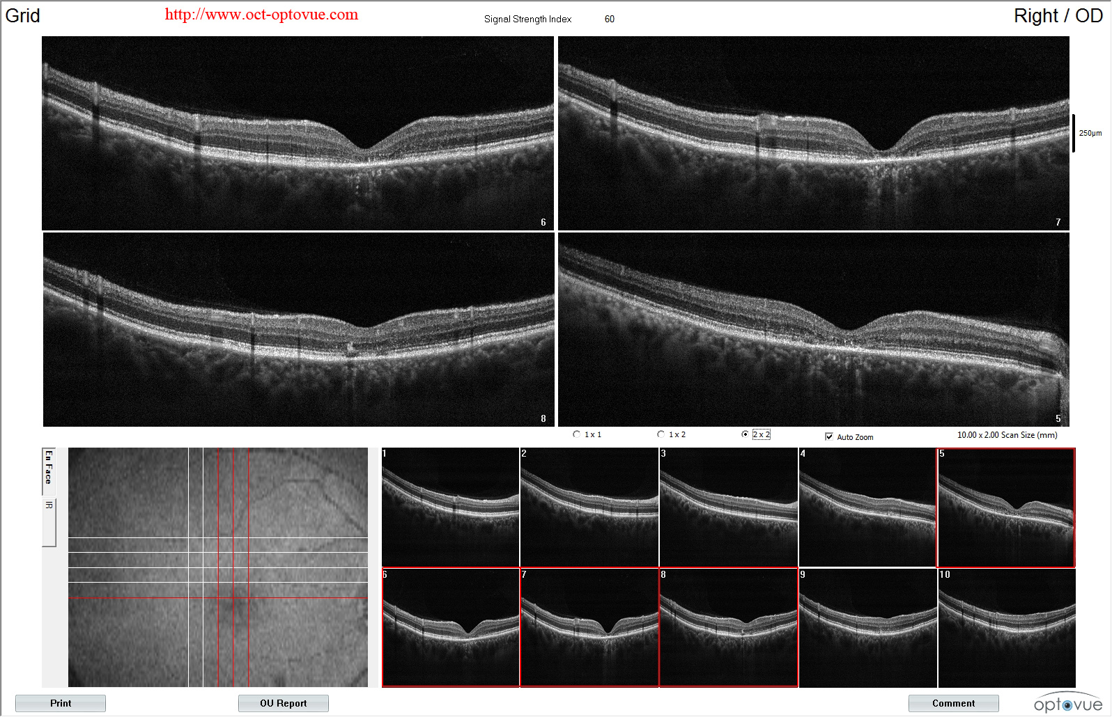 stargardt disease oct retina