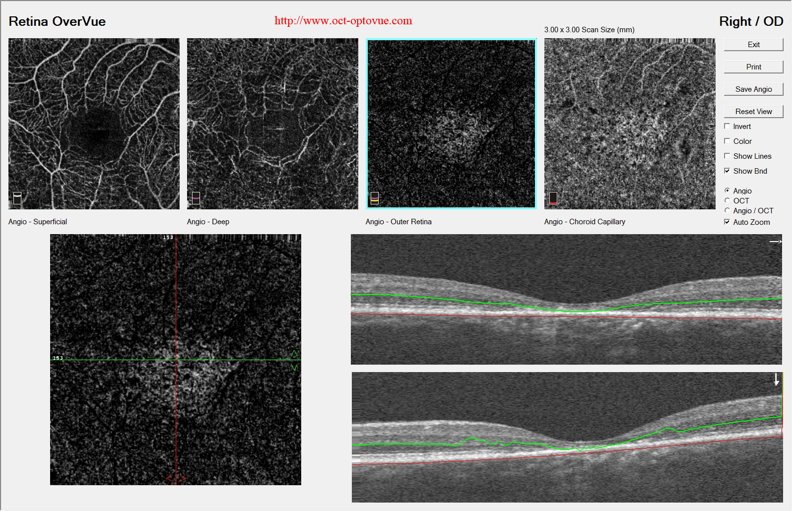 stargardt octa angiography