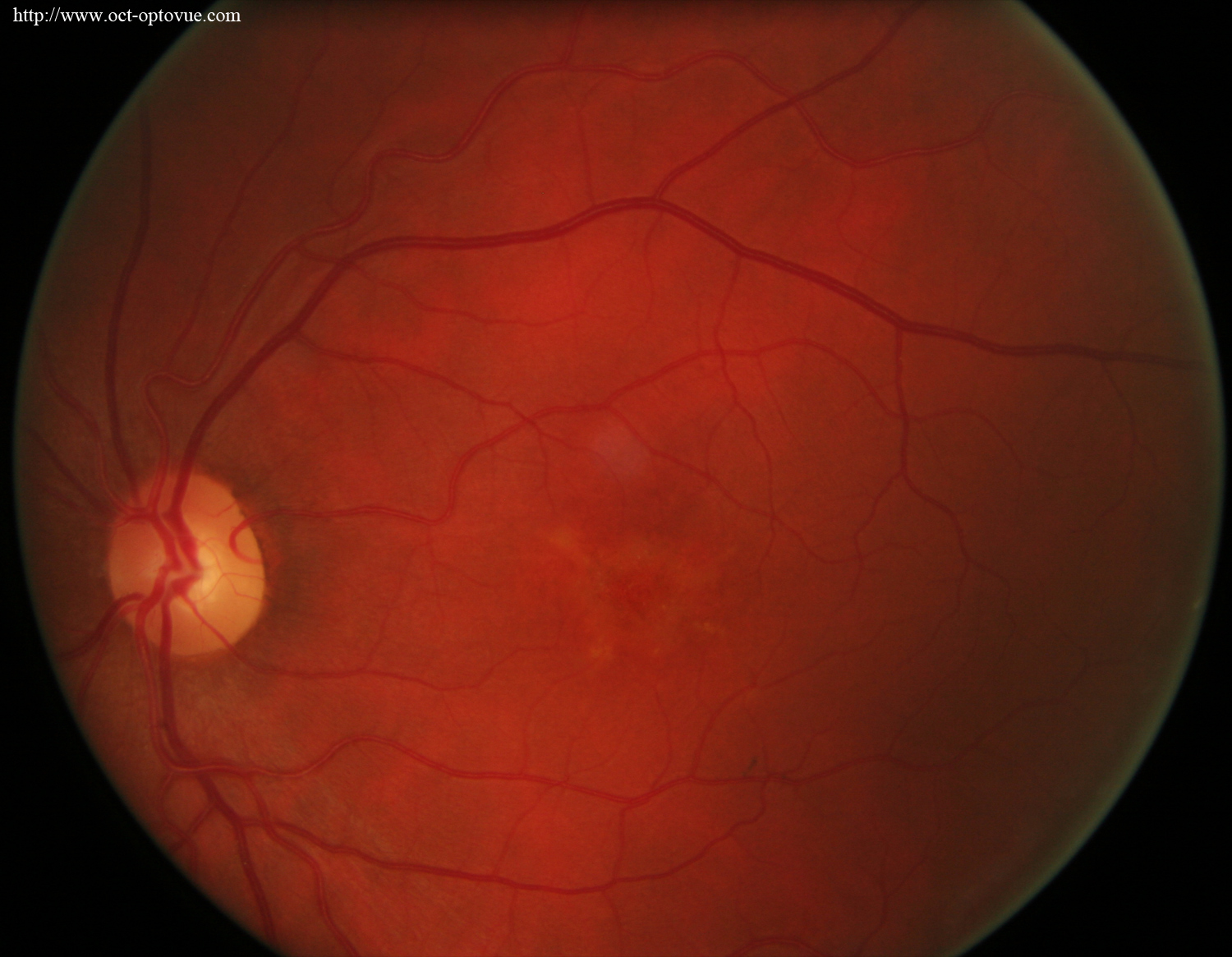 stargardt disease oct angiography